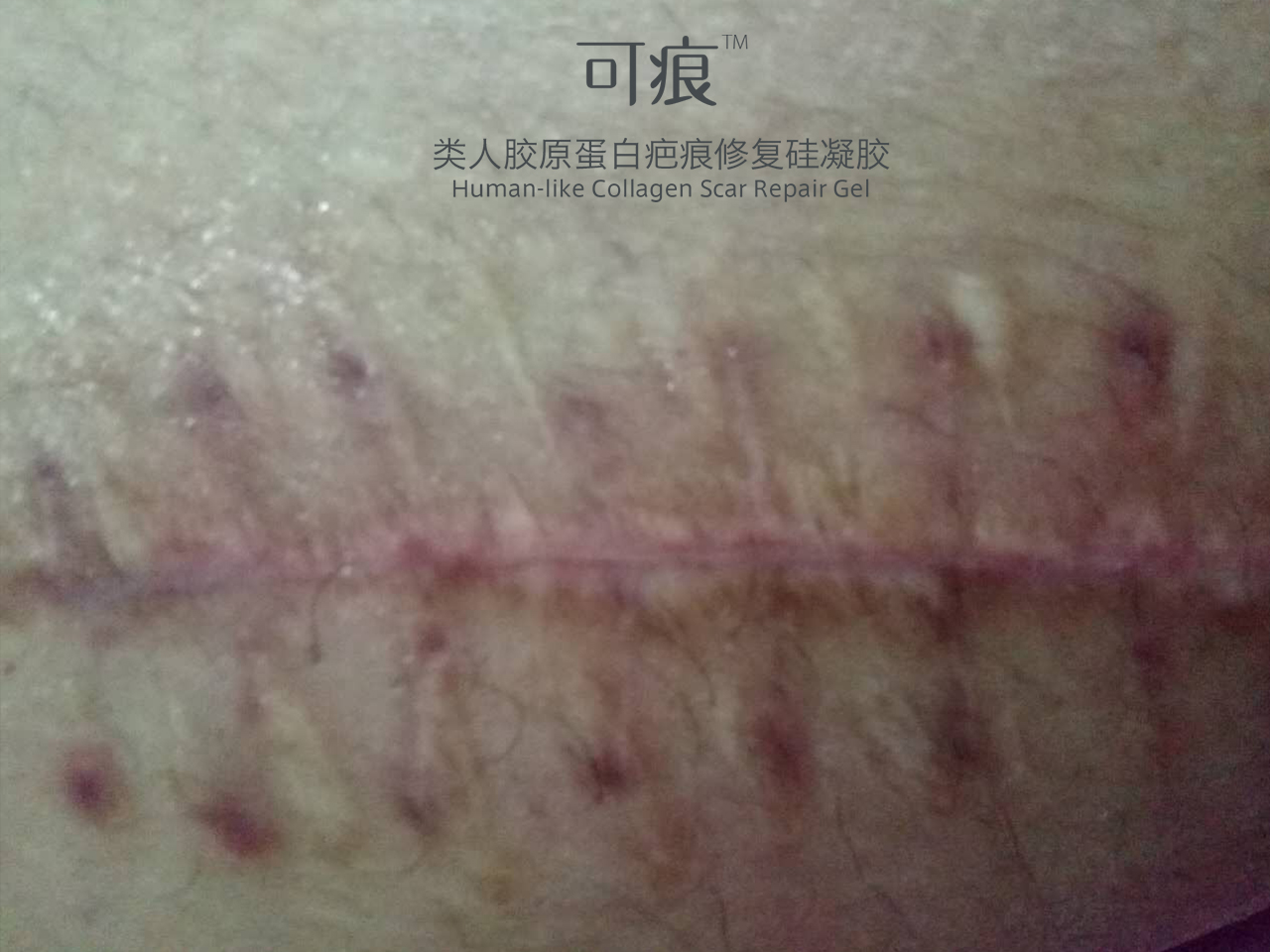  好心情好反馈  这位亲车祸大腿被化开了两次，缝了8针，掉痂后开始使用可痕类人胶原蛋白疤痕修复硅凝胶，使用一支后疤痕淡化许多，增生也减轻了，相信继续坚持使用，效果会越来越明显的~