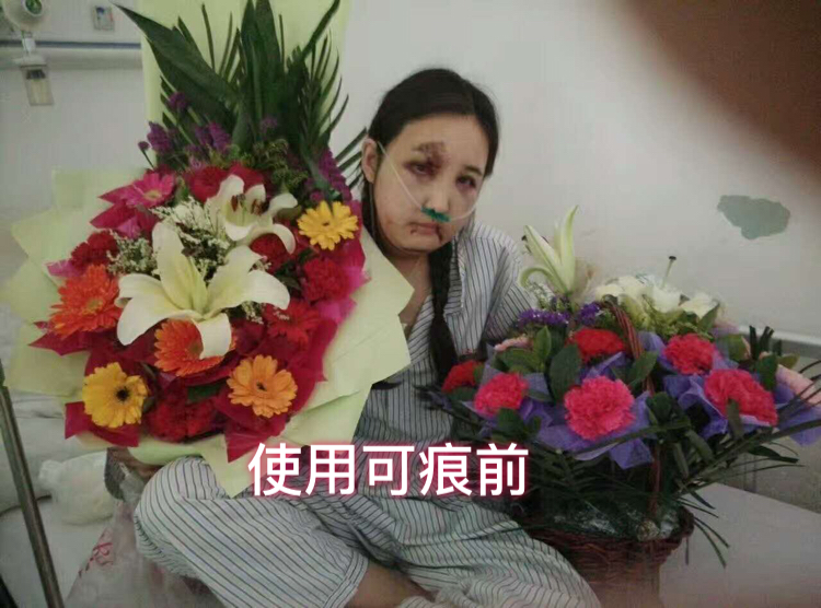 好心情好反馈 很开心可痕能帮到这位美女，车祸后她面临的不仅是面部修复，还有心理重建，很幸运，可痕不仅修复了疤痕，还帮她找回了自信，看到最后一张照片，你就明白可痕存在的意义了。而她也同意我们能把她的经历分享给大家，希望能帮助更多的人！