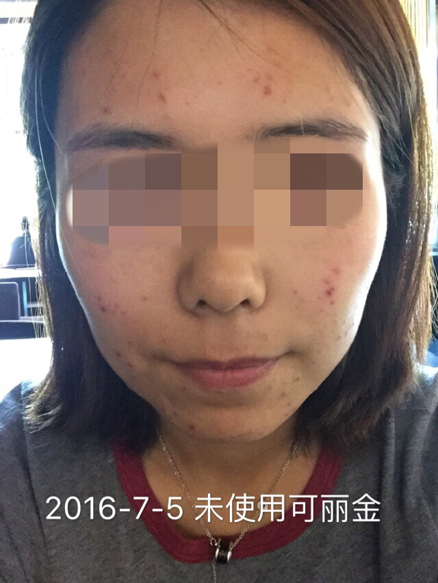 好心情好反馈 去年夏天痘痘大爆发，朋友送我了两张可丽金控油面膜，敷完发现痘痘瘪了一些，特神奇，我又买了喷雾、面霜，前期加用了可愈和可痕，后期加上了精华霜，偶尔敷一张面膜。结果痘痘越来越少，之前的痘印也都一点点下去了，拍照也敢不用美颜相机了，内心是狂喜的！