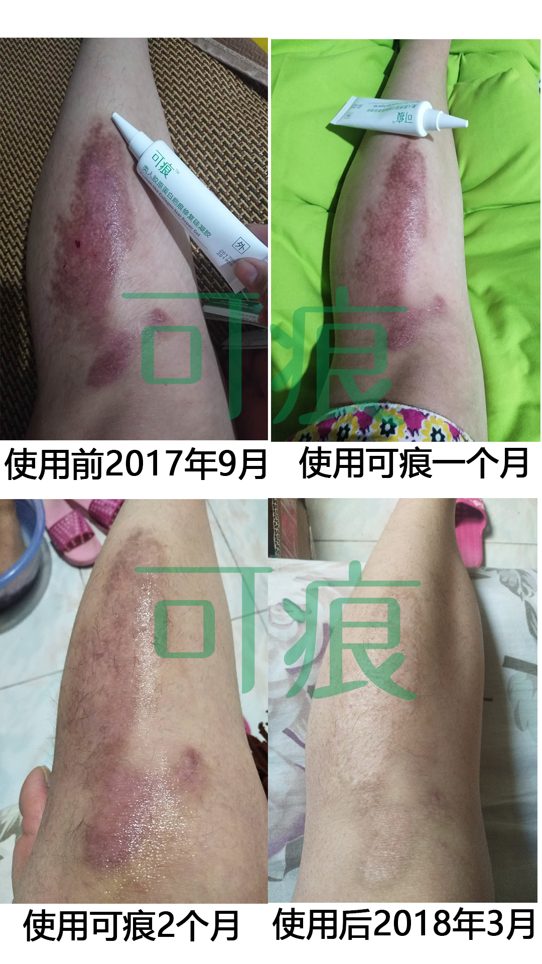 使用反馈来啦~ 从2017年9月第一次使用可痕，专门拍照记录了使用1个月、2个月时的变化，一直持续使用到2018年3月，皮肤颜色恢复到和本来皮肤相差不大，疤痕淡化到几乎没有了，再用用夏天可以大胆自信的穿裙子了 